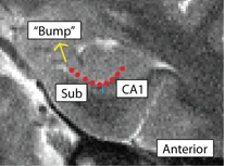 Unfolding-SubCA1 Anterior.jpg